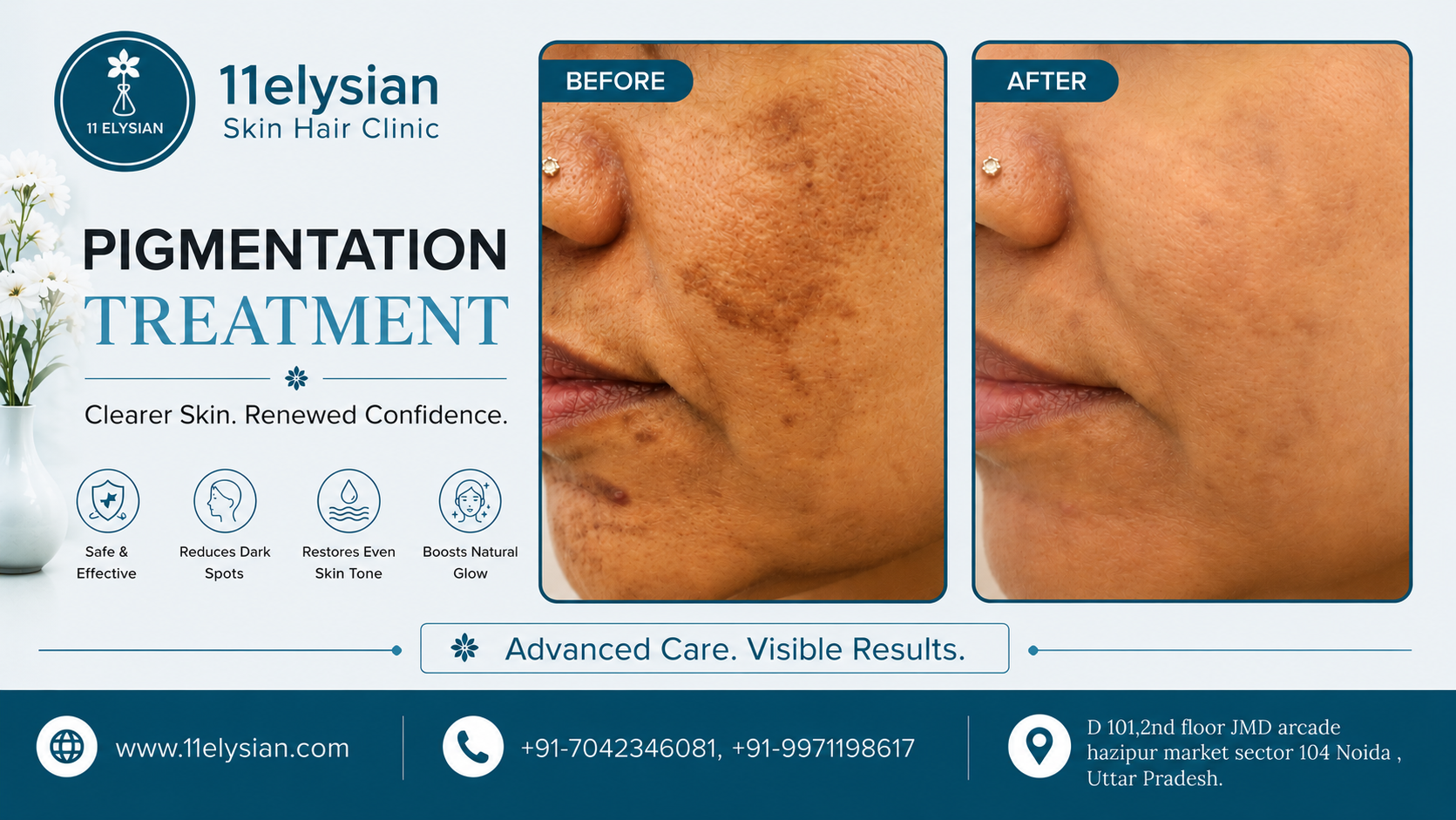 Pigmentation Treatment Near Sector 100, Noida